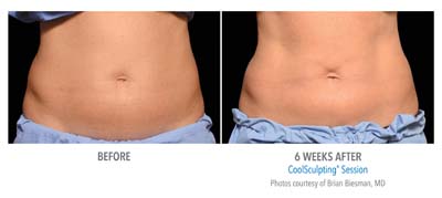 Pensacola CoolSculpting