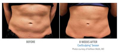 Pensacola CoolSculpting