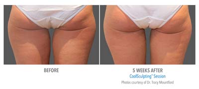 Pensacola CoolSculpting