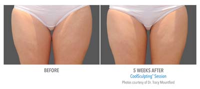 Pensacola CoolSculpting