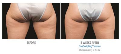 Pensacola CoolSculpting