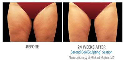 Pensacola CoolSculpting